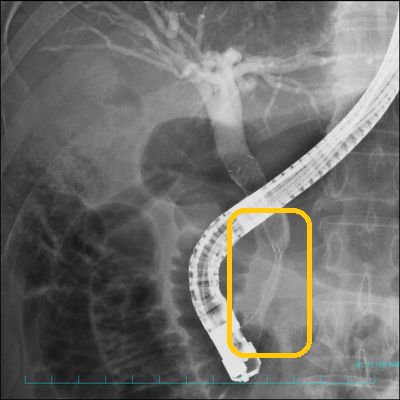 ercp2