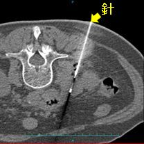 IVR_Description_Biopsy_002.jpg