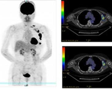 PET/CT検査の画像2