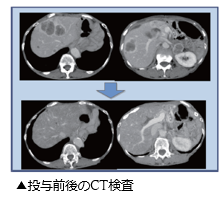 投与前後のCT検査