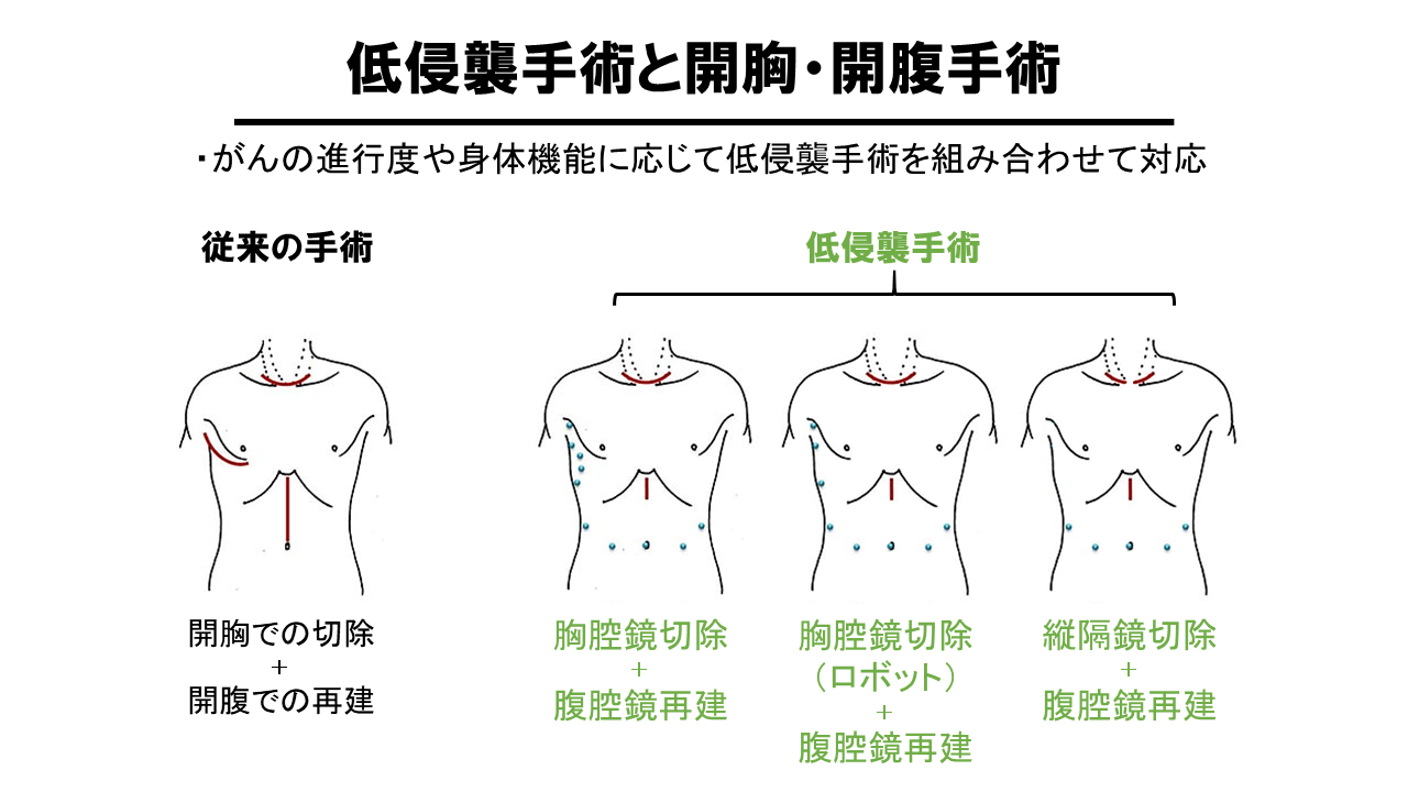 低侵襲手術と開胸・開腹手術図