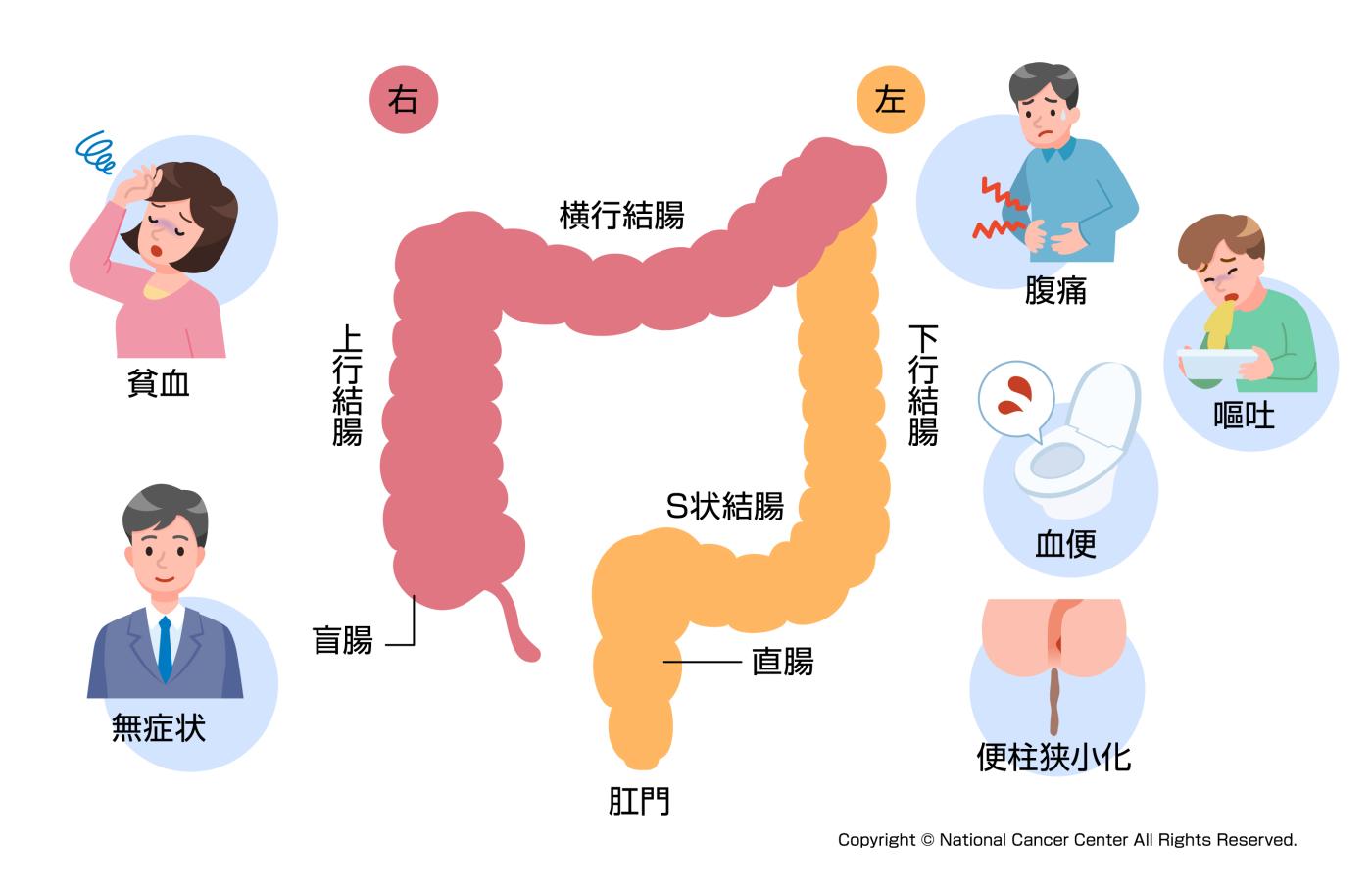 大腸 癌 で 正しい の は どれ か