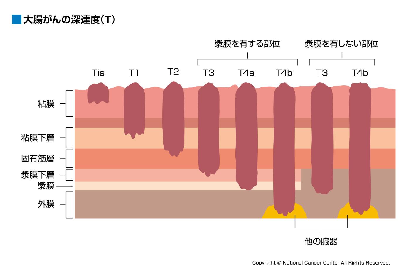 大腸がんの深達度（T)