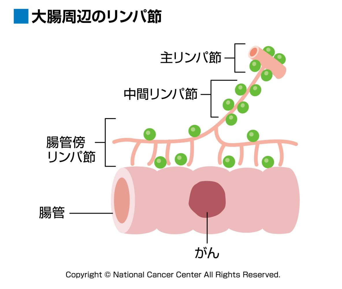 大腸周辺のリンパ節