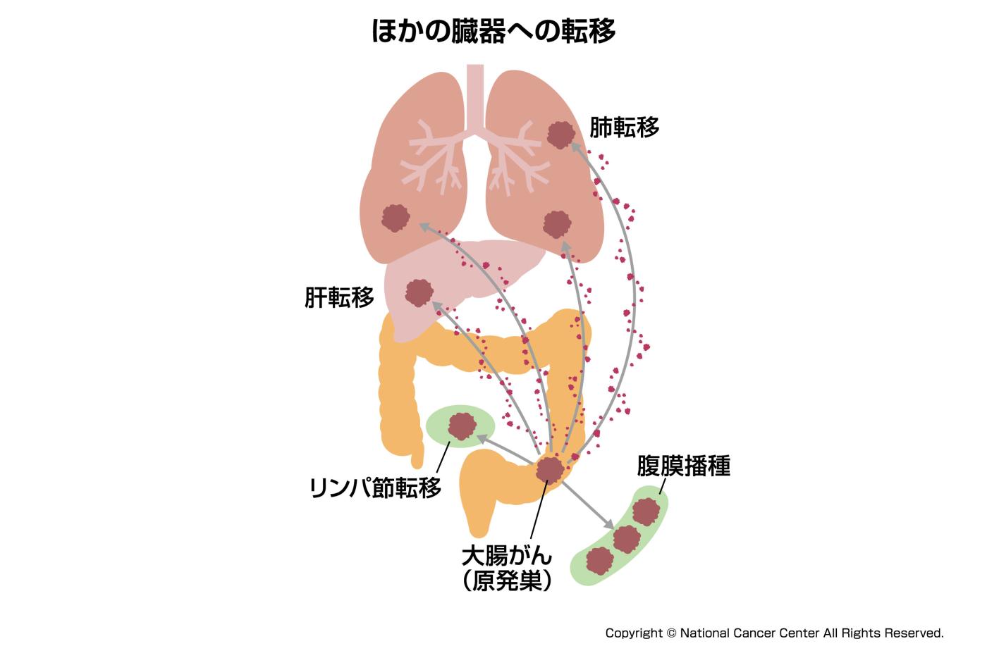 大腸がん転移の流れ