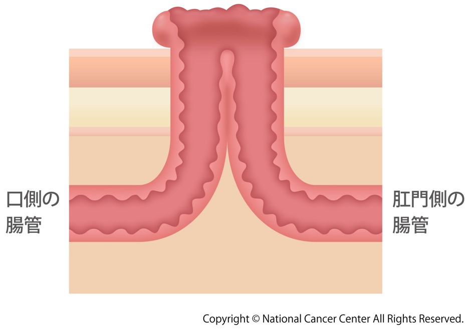 人工肛門造設術の準備方法