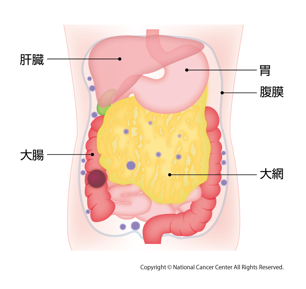 図1 腹膜播種のイメージ