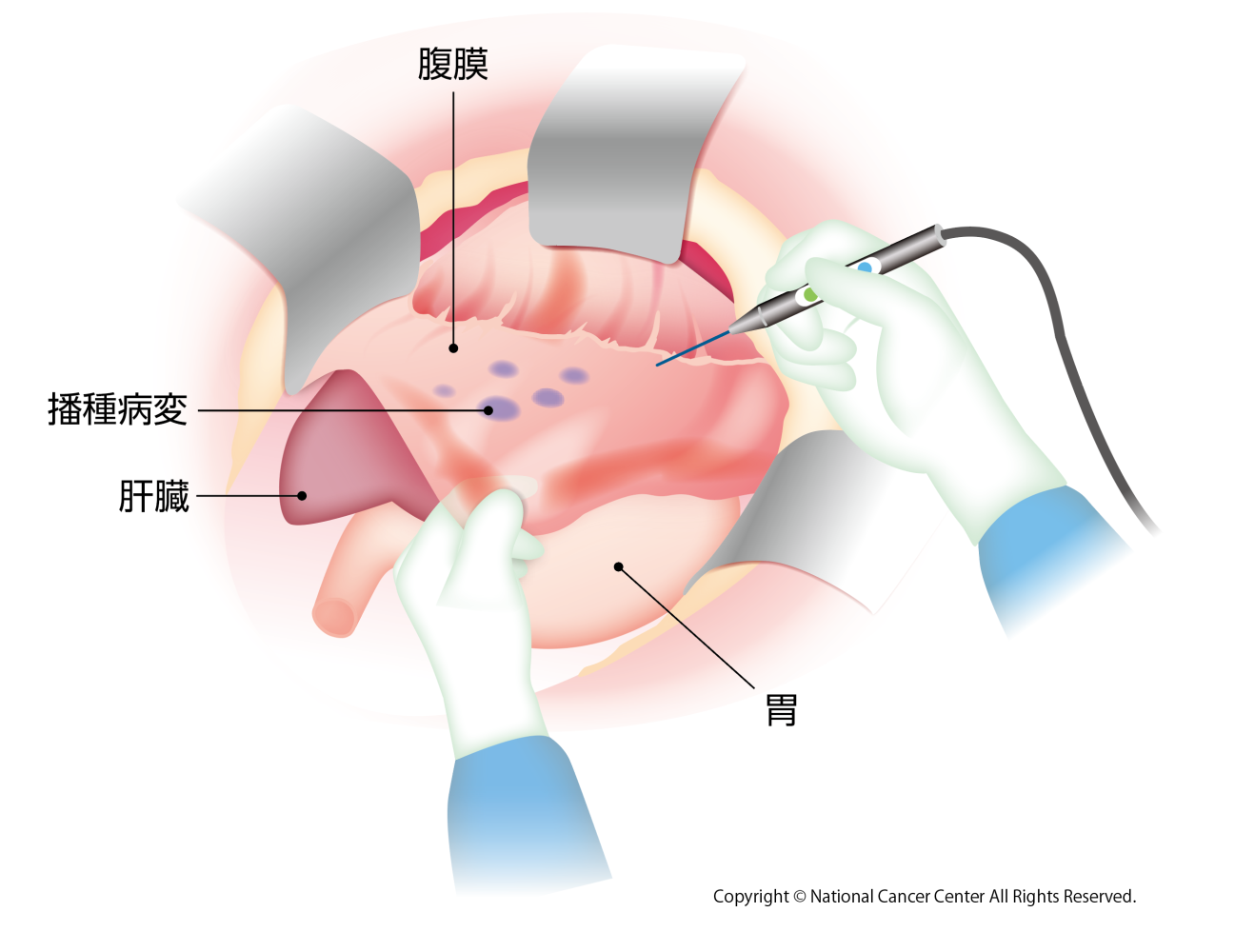 図2 完全減量手術のイメージ