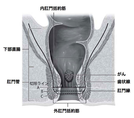 切除ラインA、B、Cの違いで、内括約筋温存の程度と術後の排便機能障害度が変わる。切除ラインが肛門に近
