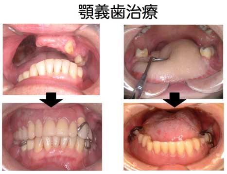 顎義歯治療