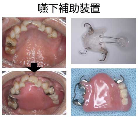 嚥下補助装置