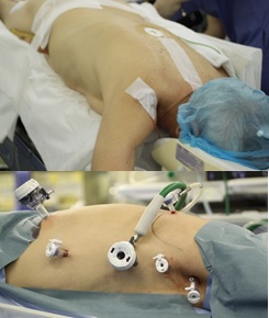 胸腔鏡下食道切除の画像