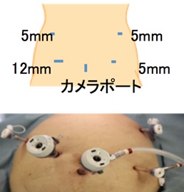 腹腔鏡下胃管再建の画像