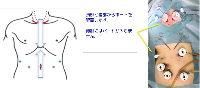 縦隔鏡下非開胸食道切除の画像