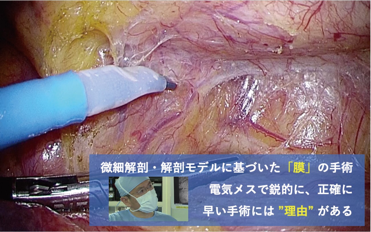 図1. 鋭的で正確で速い 微細解剖・解剖モデルに基づいた「膜」の電気メス手術中の写真