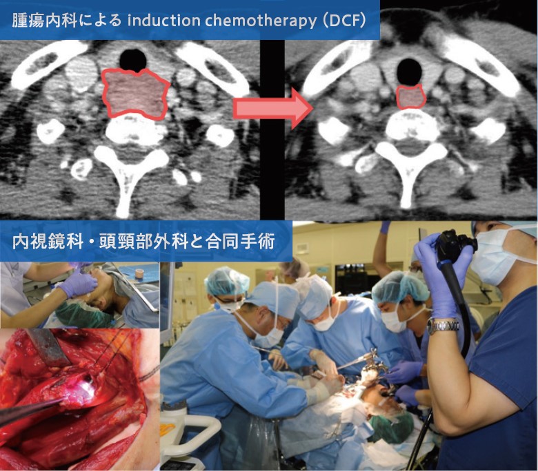 図3. 喉頭温存頚部食道切除（腫瘍内科による induction chemotherapy(DCF)、内視鏡科・頭頸部外科と合同手術）画像