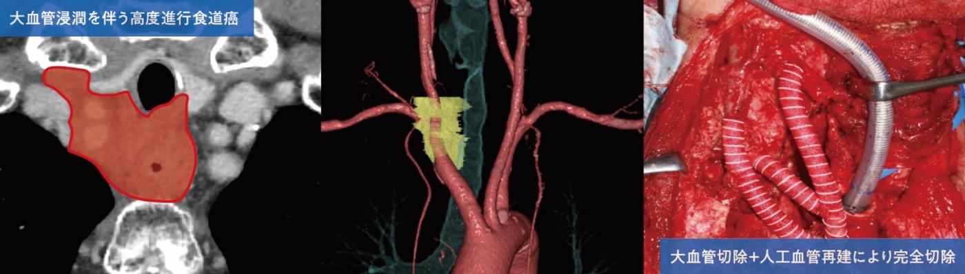 図5. 咽頭喉頭食道切除（大血管置換を伴う）、縦隔気管孔造設（大血管浸潤を伴う高度進行食道癌、大血管切除＋人工血管再建により完全切除）画像