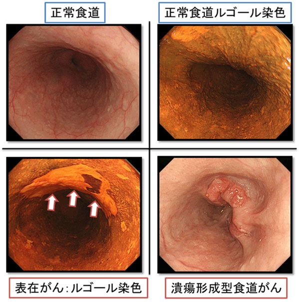 食道がんについて 国立がん研究センター 中央病院