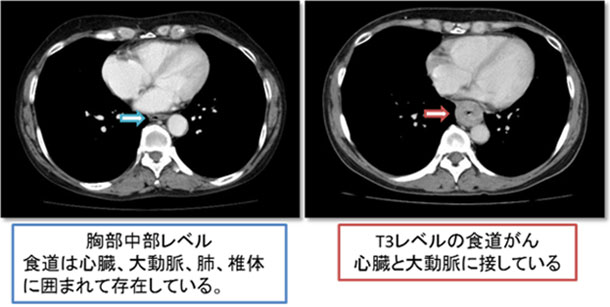 頸胸腹部CTの画像