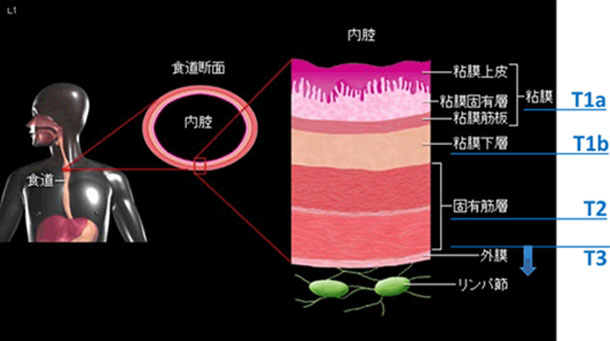 食道壁の構造とがんの深さ（T 因子）の分類の画像