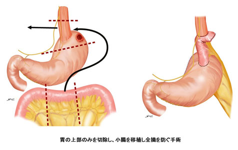 画像2　噴門側胃切除の模式図