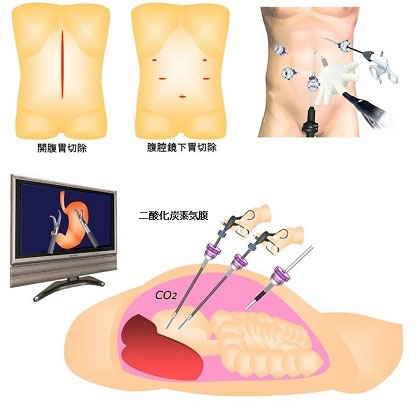 画像4　腹腔鏡下胃切除の模式図