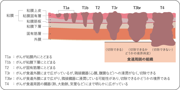 図２　食道がんの深達度