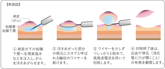 図4　内視鏡的粘膜切除術（EMR）