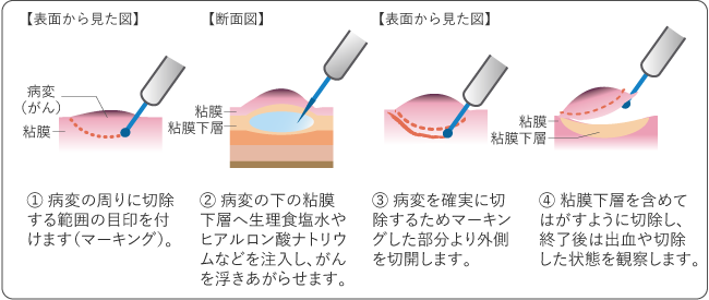 図3　内視鏡的粘膜下層剥離術（ESD）