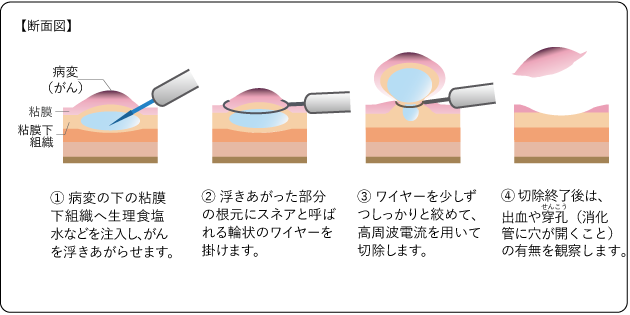図3　内視鏡的粘膜切除術（EMR）