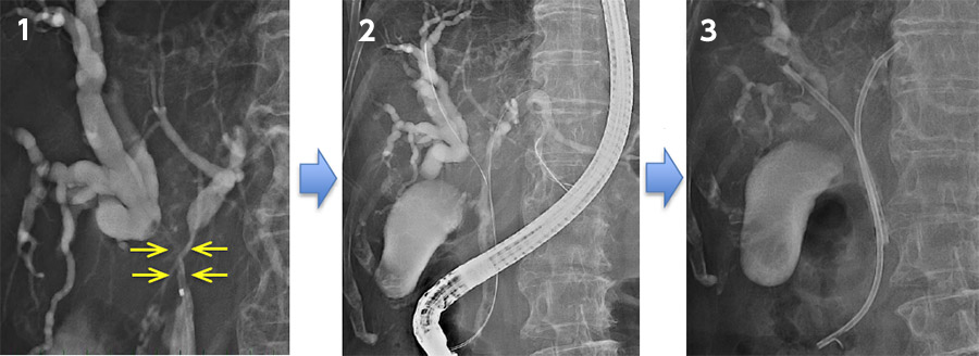 肝門部胆管癌の胆管造影と胆道ドレナージの写真 