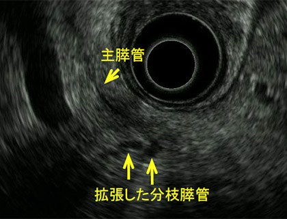主膵管拡張の精査 図1