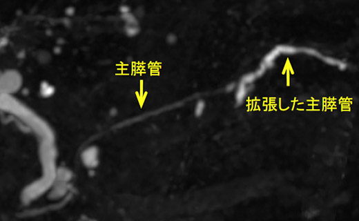 主膵管拡張の精査 図2