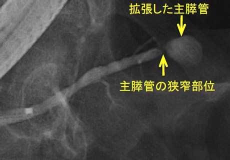 主膵管拡張の精査　図3
