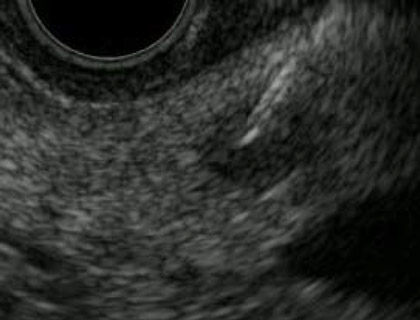 大きさ10mmのSolid pseudopapillary neoplasm(SPN) 図1