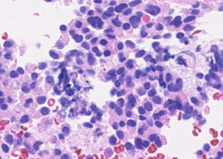 大きさ10mmのSolid pseudopapillary neoplasm（SPN）　図2