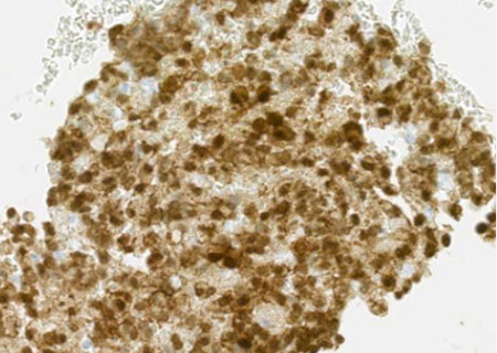 大きさ10mmのSolid pseudopapillary neoplasm（SPN）　図3