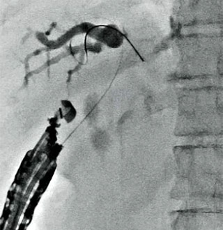 EUS- choledochoduodenostomy (EUS-CDS)　図1