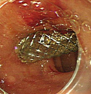 EUS- choledochoduodenostomy (EUS-CDS)　図3
