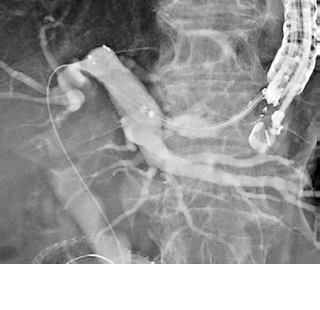 EUS- hepaticogastrostomy (EUS-HGS)　図1