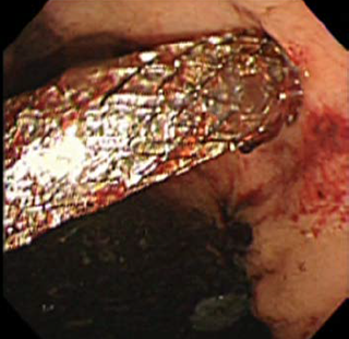 EUS- hepaticogastrostomy (EUS-HGS)　図2