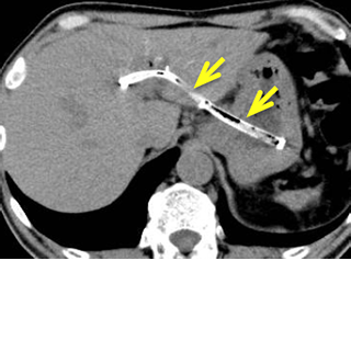 EUS- hepaticogastrostomy (EUS-HGS)　図3