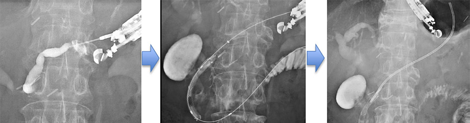 膵頭部の血腫により急性膵炎を発症した症例　図2