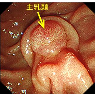 十二指腸 腫瘍