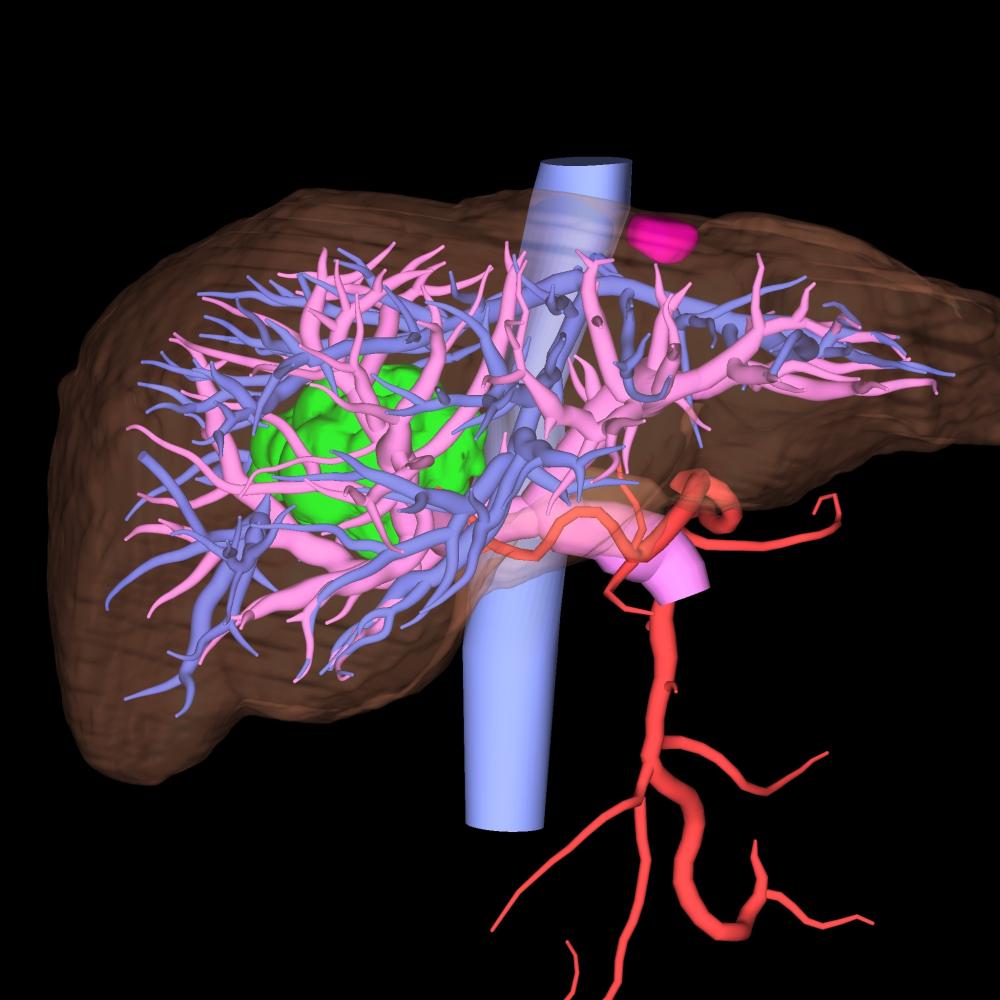 図1_CTから血管を3D構築した画像
