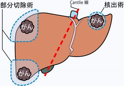 図3a_肝部分切除