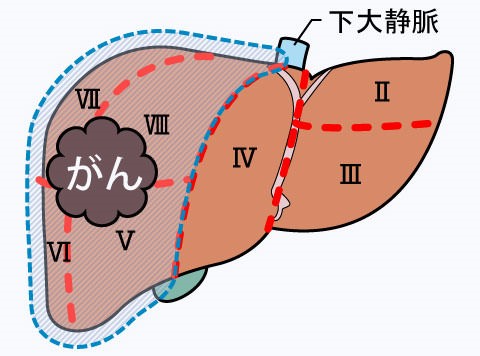 図3d_肝葉切除