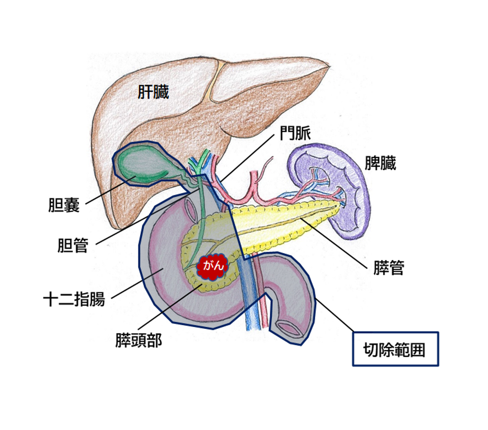 図2_膵頭十二指腸切除の範囲