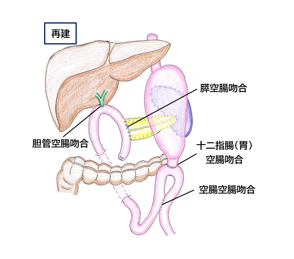 図3_膵頭十二指腸切除後の再建