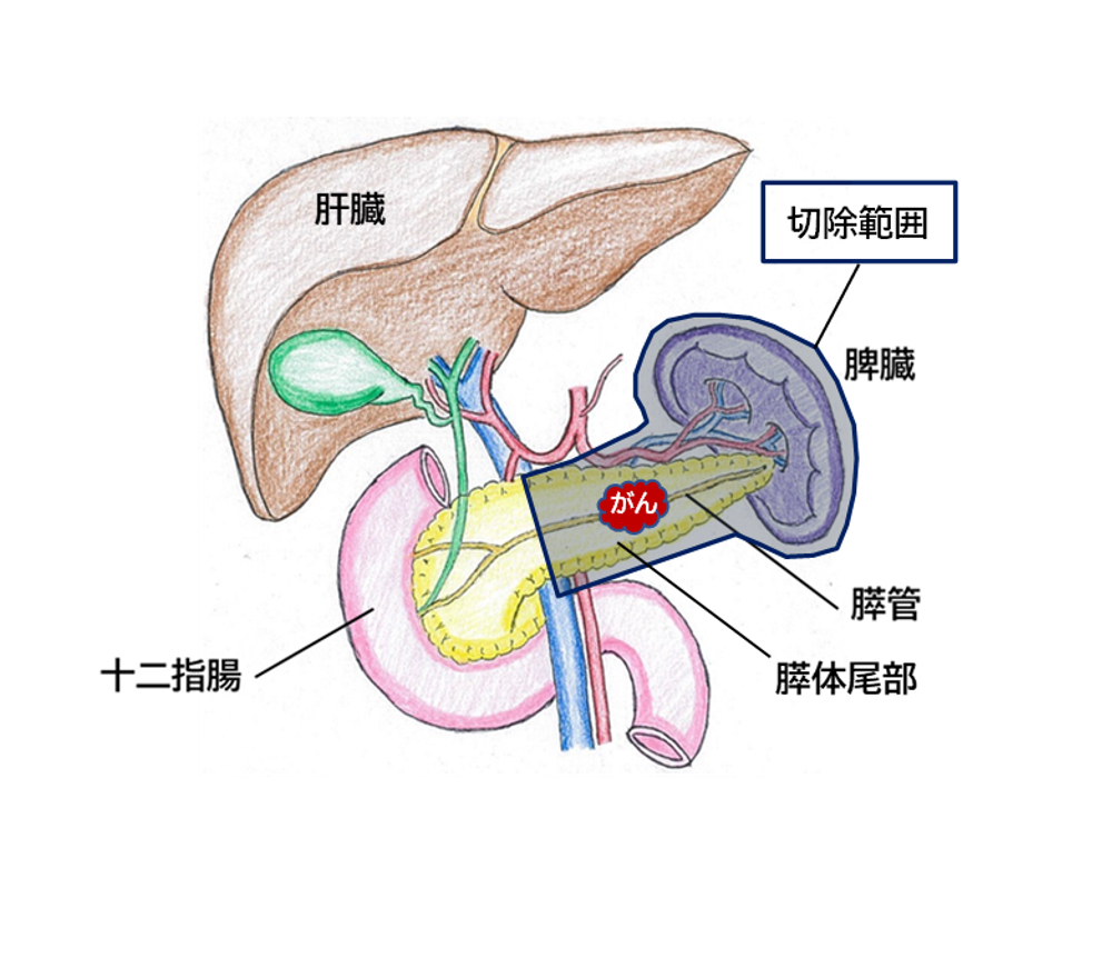 図4_膵体尾部切除の範囲